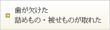 歯が欠けた詰めもの・被せものが取れた