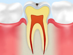 C0【ごく初期のむし歯】